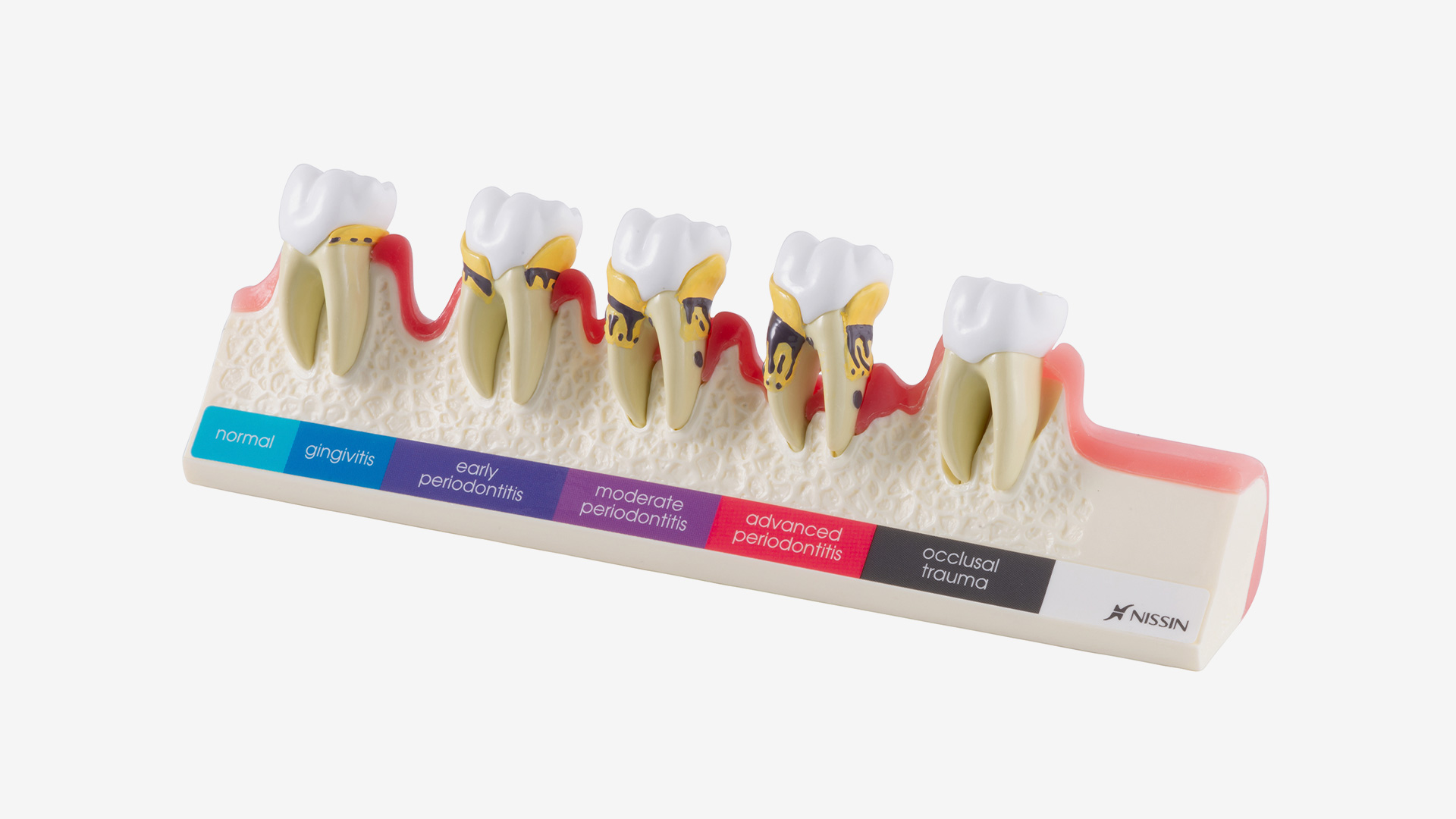 P23-PD1 Demonstrationsmodell "Parodontose-Stadien"